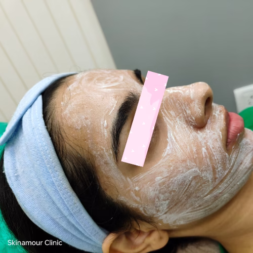 SkinAmour - Cosmetology - Chemical Peel
