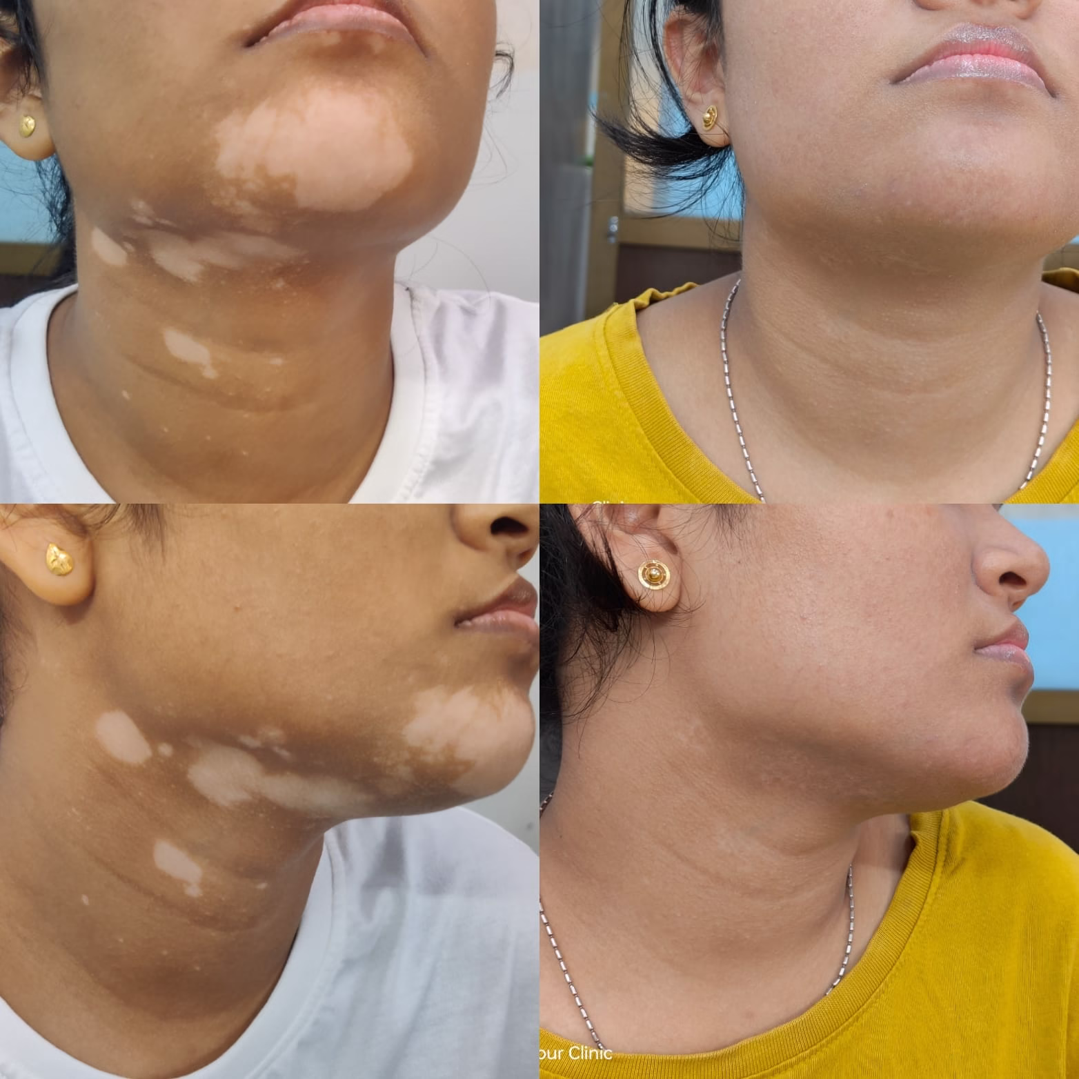 SkinAmour - Vitiligo treatment